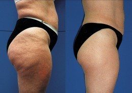 cellulite